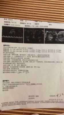 胎儿永存左上腔静脉是什么意思,四维检查胎儿永存左上腔静脉是什么意思 第3张 胎儿永存左上腔静脉是什么意思,四维检查胎儿永存左上腔静脉是什么意思 第3张