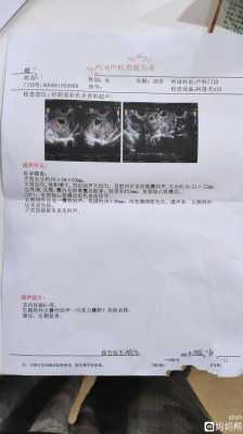 怀孕有囊肿会影响胎儿吗(怀孕有囊肿会影响胎儿吗) 第2张 怀孕有囊肿会影响胎儿吗(怀孕有囊肿会影响胎儿吗) 第2张