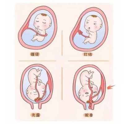 胎儿脐带绕颈是什么原因造成的（脐带绕颈是怎么引起的）  第2张