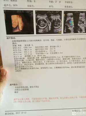 脑室增宽是什么意思。怎么治疗啊,胎儿侧脑室增宽是什么原因引起的 第3张 脑室增宽是什么意思。怎么治疗啊,胎儿侧脑室增宽是什么原因引起的 第3张