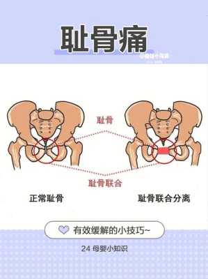 孕期耻骨疼(孕期耻骨疼有什么办法缓解) 第1张 孕期耻骨疼(孕期耻骨疼有什么办法缓解) 第1张