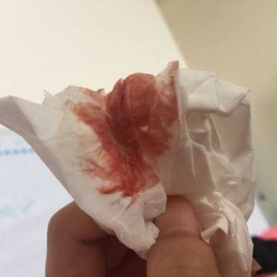 孕期出血正常吗(在易孕期出血正常吗) 第2张 孕期出血正常吗(在易孕期出血正常吗) 第2张