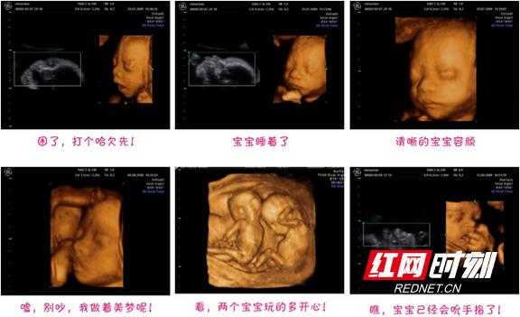 孕期b超做多了会影响胎儿吗(孕晚期多久做一次b超合适?做多了对胎儿有影响吗) 第2张 孕期b超做多了会影响胎儿吗(孕晚期多久做一次b超合适?做多了对胎儿有影响吗) 第2张
