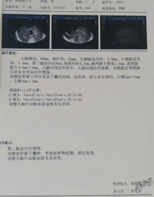 宝宝的室管膜下囊肿怎么样了,胎儿囊肿会自己消失吗吃什么消失的快 第2张 宝宝的室管膜下囊肿怎么样了,胎儿囊肿会自己消失吗吃什么消失的快 第2张