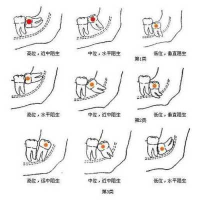孕期可以拔智齿吗(孕期可以拔智齿吗?) 第1张 孕期可以拔智齿吗(孕期可以拔智齿吗?) 第1张
