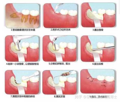 孕期可以拔智齿吗（孕期可以拔智齿吗?）  第2张