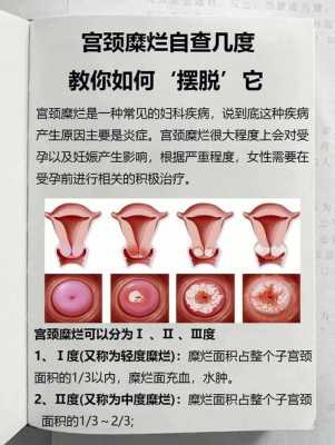 孕期宫颈糜烂怎么办(孕期宫颈糜烂怎么办呢) 第1张 孕期宫颈糜烂怎么办(孕期宫颈糜烂怎么办呢) 第1张