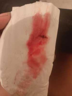 孕期流血有哪些原因(先兆流产流血量图片) 第1张 孕期流血有哪些原因(先兆流产流血量图片) 第1张