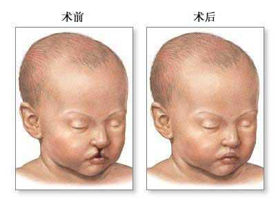 唇腭裂是怎么造成的,胎儿唇腭裂能修复吗 第2张 唇腭裂是怎么造成的,胎儿唇腭裂能修复吗 第2张