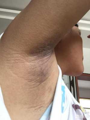 孕期腋窝变黑怎么回事(怀孕腋下变黑怎么办) 第1张 孕期腋窝变黑怎么回事(怀孕腋下变黑怎么办) 第1张