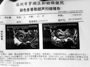 流产一个月后又怀孕孩子可以要吗,一个月胎儿流产图片 45天  第2张