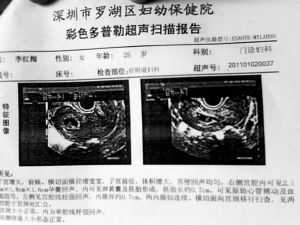 流产一个月后又怀孕孩子可以要吗,一个月胎儿流产图片 45天 第2张 流产一个月后又怀孕孩子可以要吗,一个月胎儿流产图片 45天 第2张