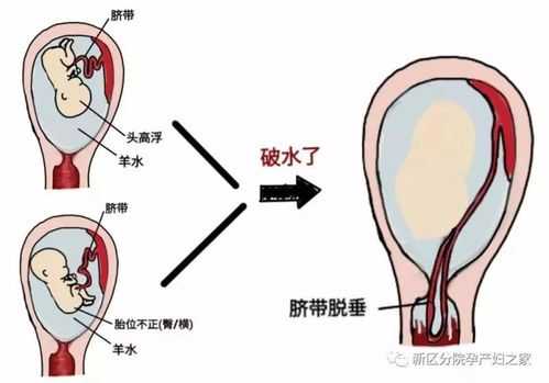 孕期怎么预防胎膜早破(内裤有一小片湿算破水吗) 第2张 孕期怎么预防胎膜早破(内裤有一小片湿算破水吗) 第2张