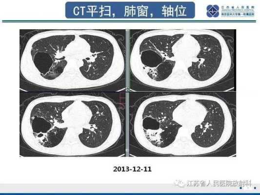 胎儿肺囊腺瘤（胎儿肺囊腺瘤是什么原因造成的）  第2张