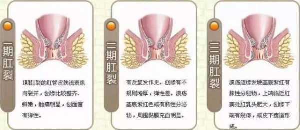 孕期肛门出血怎么回事(孕期肛门出血怎么回事儿) 第2张 孕期肛门出血怎么回事(孕期肛门出血怎么回事儿) 第2张