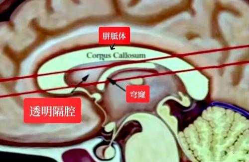 胎儿透明隔腔偏小(胎儿透明隔腔偏小是什么原因造成的) 第2张 胎儿透明隔腔偏小(胎儿透明隔腔偏小是什么原因造成的) 第2张