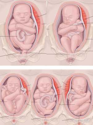 胎儿臀位能顺产吗（胎儿臀位能顺产吗）  第2张