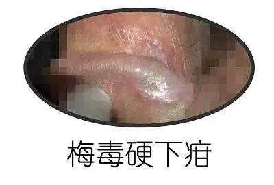 梅毒会传染给胎儿吗(孕妇梅毒会传染给胎儿吗) 第1张 梅毒会传染给胎儿吗(孕妇梅毒会传染给胎儿吗) 第1张