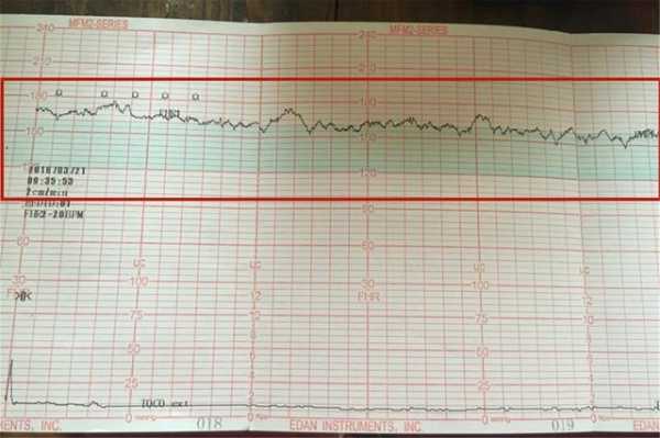 胎心正常胎儿会缺氧吗（胎心正常胎儿会缺氧吗）  第2张