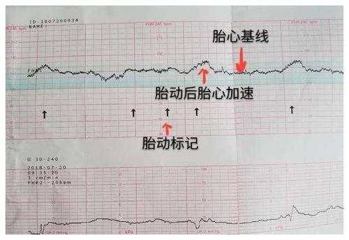 胎心监测时宝宝不动怎么办,胎心监护胎儿不动怎么办吸氧也不动  第1张