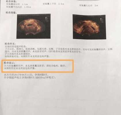 胎儿没胎心是怎么回事(怀孕两个月胎儿没胎心是怎么回事) 第1张 胎儿没胎心是怎么回事(怀孕两个月胎儿没胎心是怎么回事) 第1张