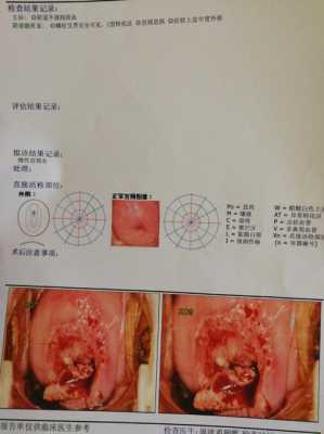 孕期宫颈息肉怎么办,孕期宫颈息肉一直有少量出血怎么办 第2张 孕期宫颈息肉怎么办,孕期宫颈息肉一直有少量出血怎么办 第2张