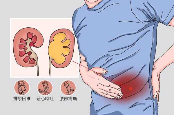 孕期肾积水(孕晚期,双肾积水怎么回事) 第2张 孕期肾积水(孕晚期,双肾积水怎么回事) 第2张