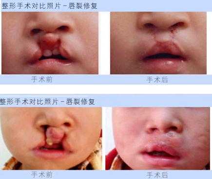胎儿唇裂是什么原因造成的(兔唇的原因有哪些) 第1张 胎儿唇裂是什么原因造成的(兔唇的原因有哪些) 第1张