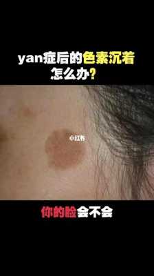 怀孕时的黑色素多久可以消,孕期黑色素沉淀产后多久恢复 第2张 怀孕时的黑色素多久可以消,孕期黑色素沉淀产后多久恢复 第2张
