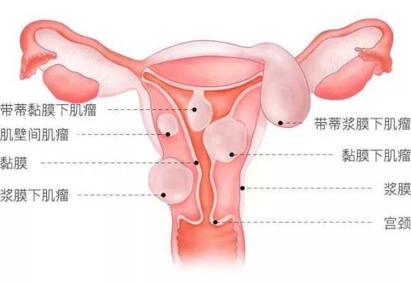 怀孕了子宫肌瘤对胎儿有影响吗(怀孕了子宫肌瘤对胎儿有影响吗,有风险吗?) 第2张 怀孕了子宫肌瘤对胎儿有影响吗(怀孕了子宫肌瘤对胎儿有影响吗,有风险吗?) 第2张