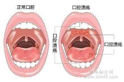 孕期口腔溃疡(孕期口腔溃疡怎么办最快最有效的方法) 第2张 孕期口腔溃疡(孕期口腔溃疡怎么办最快最有效的方法) 第2张