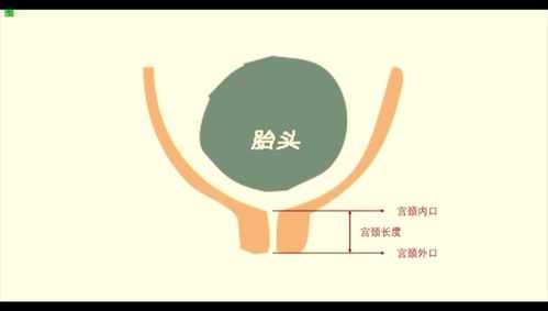 孕期宫颈长度（怀孕24周宫颈管多长是正常）  第1张