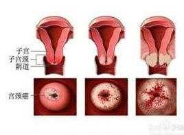 孕期阴道出血（孕期下面出血但不疼什么情况）  第1张