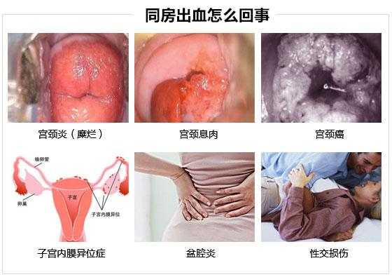 孕期同房出血（同房出血有哪些原因）  第1张