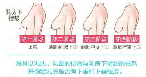 怀孕乳房下垂怎么纠正?方法是什么啊,孕期胸下垂正常吗 第2张 怀孕乳房下垂怎么纠正?方法是什么啊,孕期胸下垂正常吗 第2张