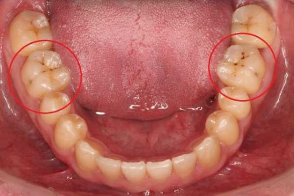 孕期蛀牙怎么办（孕期蛀牙怎么办才能治好）  第3张