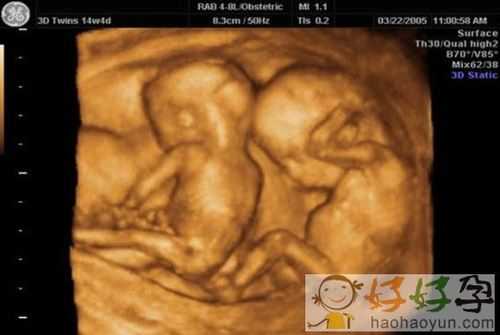 八个月孩子17斤正常吗,双胎8个月胎儿有多重  第2张