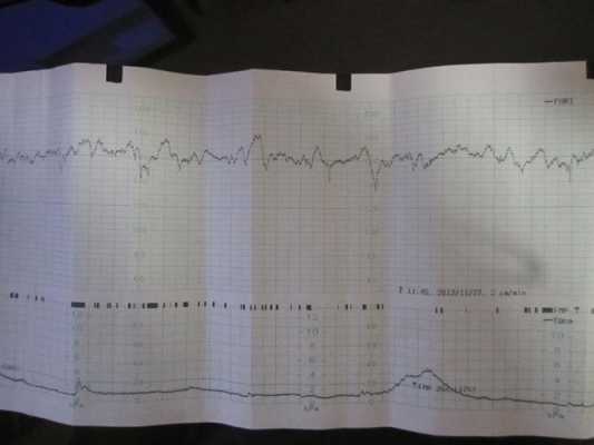 胎儿心跳160以上（胎心监护，宝宝在胎动时心跳超过160）  第1张