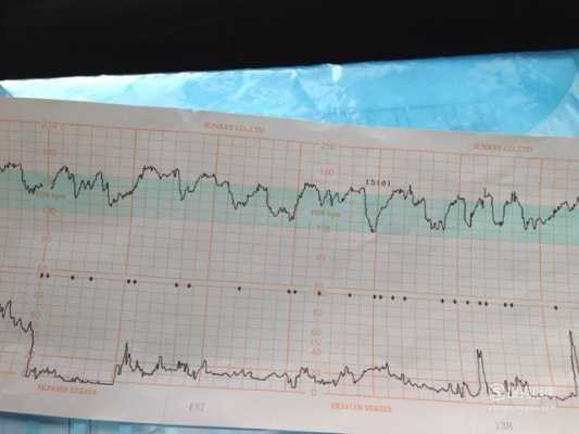 胎儿心跳160以上（胎心监护，宝宝在胎动时心跳超过160）  第2张