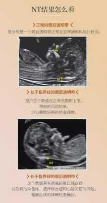 胎儿nt增厚怎么办(做nt被医生说腹壁太厚) 第2张 胎儿nt增厚怎么办(做nt被医生说腹壁太厚) 第2张