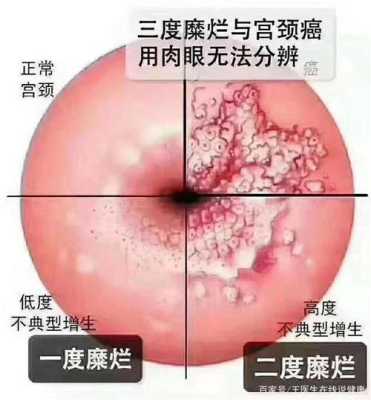 怀孕期间宫颈糜烂(中度宫糜烂对胎儿有应响) 第2张 怀孕期间宫颈糜烂(中度宫糜烂对胎儿有应响) 第2张