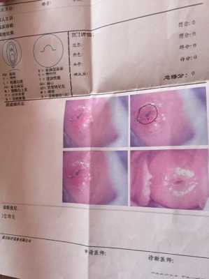 怀孕期间宫颈糜烂(中度宫糜烂对胎儿有应响) 第3张 怀孕期间宫颈糜烂(中度宫糜烂对胎儿有应响) 第3张