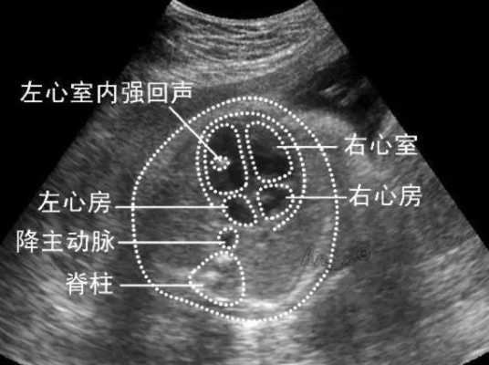 胎儿左心室强回声是什么意思（左心室显示一强回声光点什么意思）  第2张