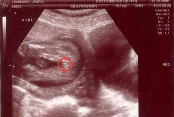 孕35周，孩子都六斤多了，应该怎么控制,6周大的胎儿图片b超图  第2张