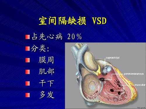 室间隔缺损的胎儿多吗(小儿室间隔缺损崤下型能自愈吗) 第2张 室间隔缺损的胎儿多吗(小儿室间隔缺损崤下型能自愈吗) 第2张