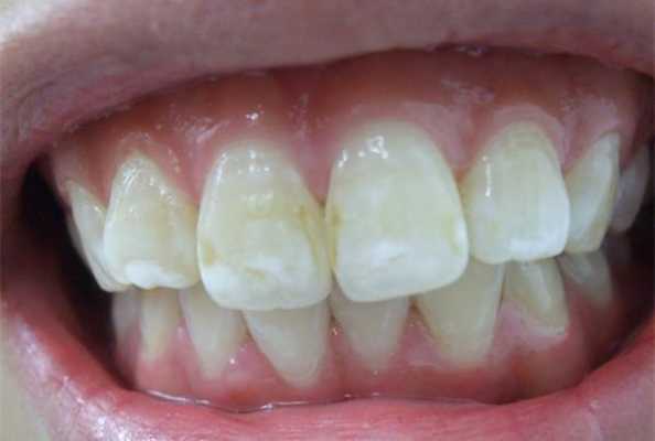 孕期牙齿发炎怎么办(牙银发炎怎么办?孕晚期时候了,可以吃哪些食物好啊) 第2张 孕期牙齿发炎怎么办(牙银发炎怎么办?孕晚期时候了,可以吃哪些食物好啊) 第2张