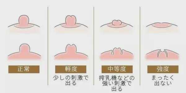 孕期乳头有白色分泌物(孕期乳头有白色分泌物正常么) 第2张 孕期乳头有白色分泌物(孕期乳头有白色分泌物正常么) 第2张