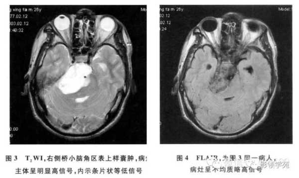 胎儿脑部囊肿能不能要(脑部囊肿严重吗) 第2张 胎儿脑部囊肿能不能要(脑部囊肿严重吗) 第2张