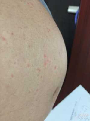孕期肚子上长小红点(孕妇肚子上长了红点点,很痒,怎么办) 第3张 孕期肚子上长小红点(孕妇肚子上长了红点点,很痒,怎么办) 第3张