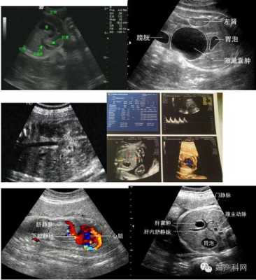 第一次产检为什么要做彩色多普勒超声常规检查,胎儿系统彩色多普勒超声检查 大排畸  第2张